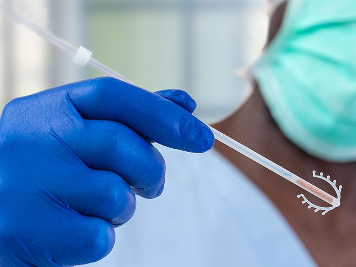Copper IUD: Efficacy, Benefits, Side Effects, and Procedure