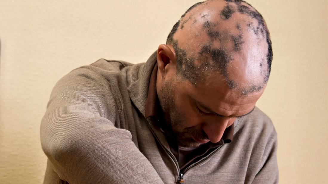 Mental & Emotional Stress of Alopecia Areata