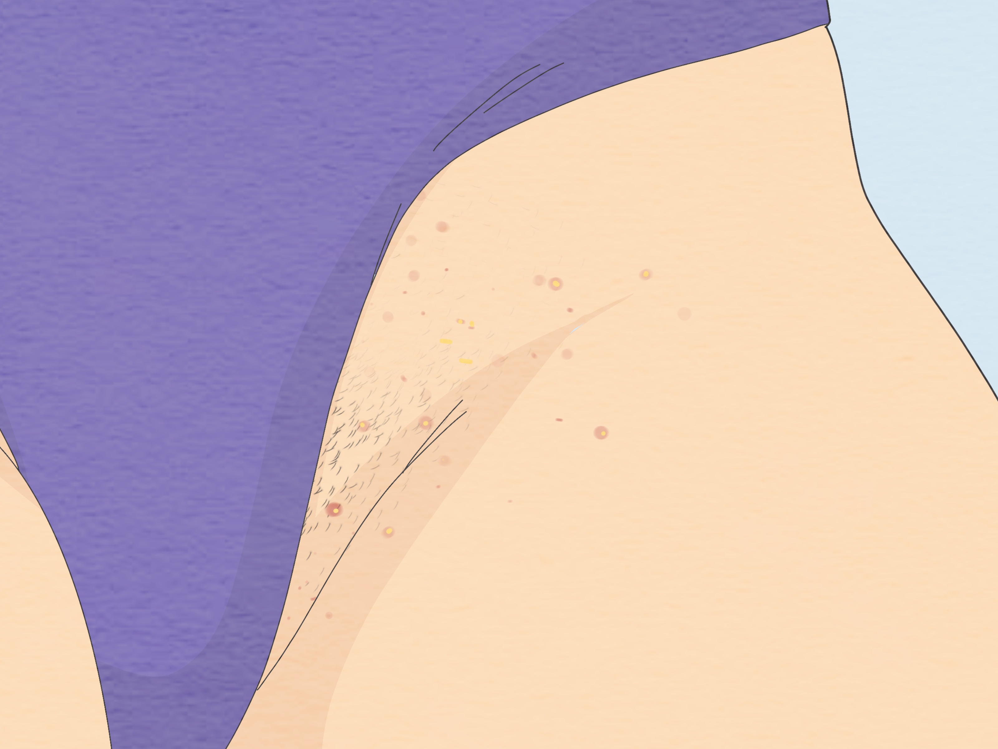 How to Get Rid of Fordyce Spots: 12 Steps