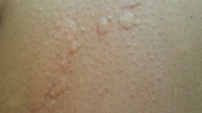 Hives: Causes, Risks, Prevention, and Pictures